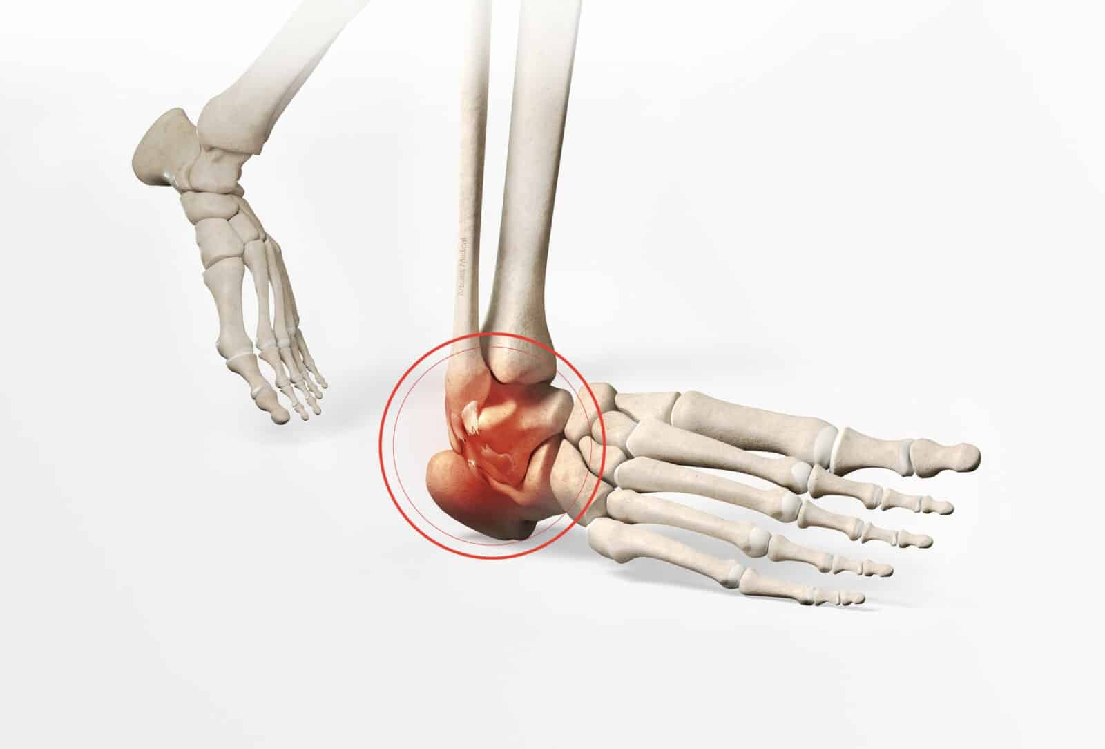 découvrez les causes courantes de la déchirure des ligaments de la cheville et les options de traitements efficaces pour une récupération optimale.