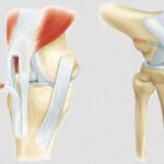 découvrez la durée moyenne d'hospitalisation après une intervention pour ligament croisé, les étapes de récupération, et les conseils pour un retour à la maison en toute sérénité.