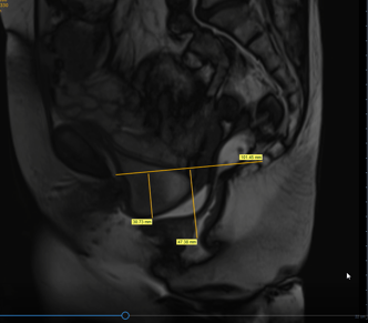 découvrez notre guide complet sur l'irm pelvienne, incluant les indications, la préparation, le déroulement de l'examen et les résultats pour mieux comprendre cette technique d'imagerie médicale.