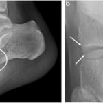 Qu&rsquo;est-ce qu&rsquo;un arrachement osseux et comment le reconnaître