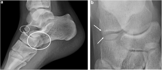 découvrez la définition de l'arrachement osseux et apprenez à reconnaître ses symptômes pour une prise en charge efficace.
