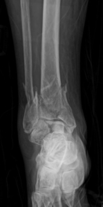 découvrez tout sur l'arrachement osseux de la malléole externe : causes, symptômes, traitements et conseils pour une guérison optimale.