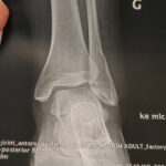 Petit arrachement osseux de la malléole externe : causes, symptômes et traitements