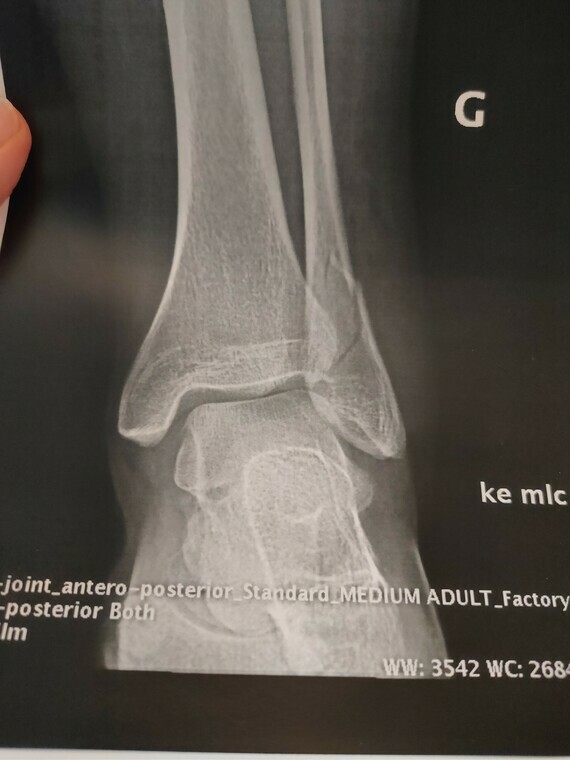découvrez les symptômes, causes et traitements de l'arrachement osseux de la malléole externe, une blessure fréquente nécessitant une prise en charge adaptée pour une récupération optimale.