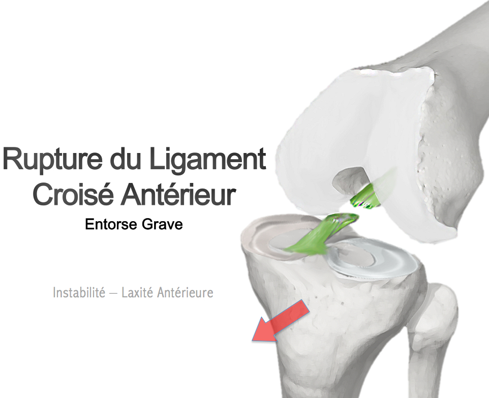 découvrez notre formation spécialisée en cicatrisation du ligament croisé, alliant techniques avancées et pratiques de rééducation pour une récupération optimale.