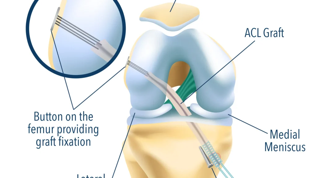 découvrez tout sur la chirurgie du ligament croisé antérieur (lca) : procédures, rééducation et conseils pour une récupération optimale.