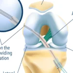 découvrez tout sur la chirurgie du ligament croisé antérieur (lca) : procédures, rééducation et conseils pour une récupération optimale.