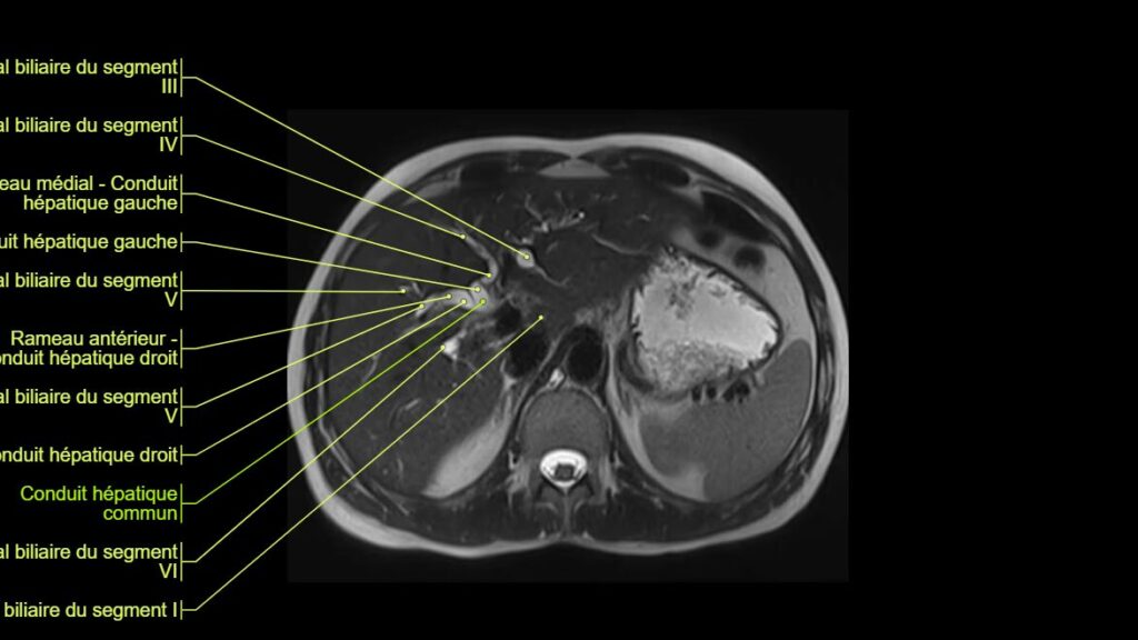 découvrez tout sur la bili irm, une méthode d'imagerie médicale essentielle pour le diagnostic précis. informations, usages et avantages expliqués simplement.