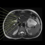 découvrez tout sur la bili irm, une méthode d'imagerie médicale essentielle pour le diagnostic précis. informations, usages et avantages expliqués simplement.