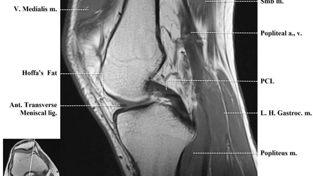 guide complet pour l'interprétation des irm du genou, comprenant l'analyse des structures anatomiques, des lésions courantes et des pathologies associées.