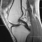 guide complet pour l'interprétation des irm du genou, comprenant l'analyse des structures anatomiques, des lésions courantes et des pathologies associées.