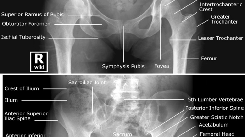 découvrez tout sur la radiographie pelvienne : préparation, procédure, indications et interprétation pour un diagnostic précis des affections du bassin.