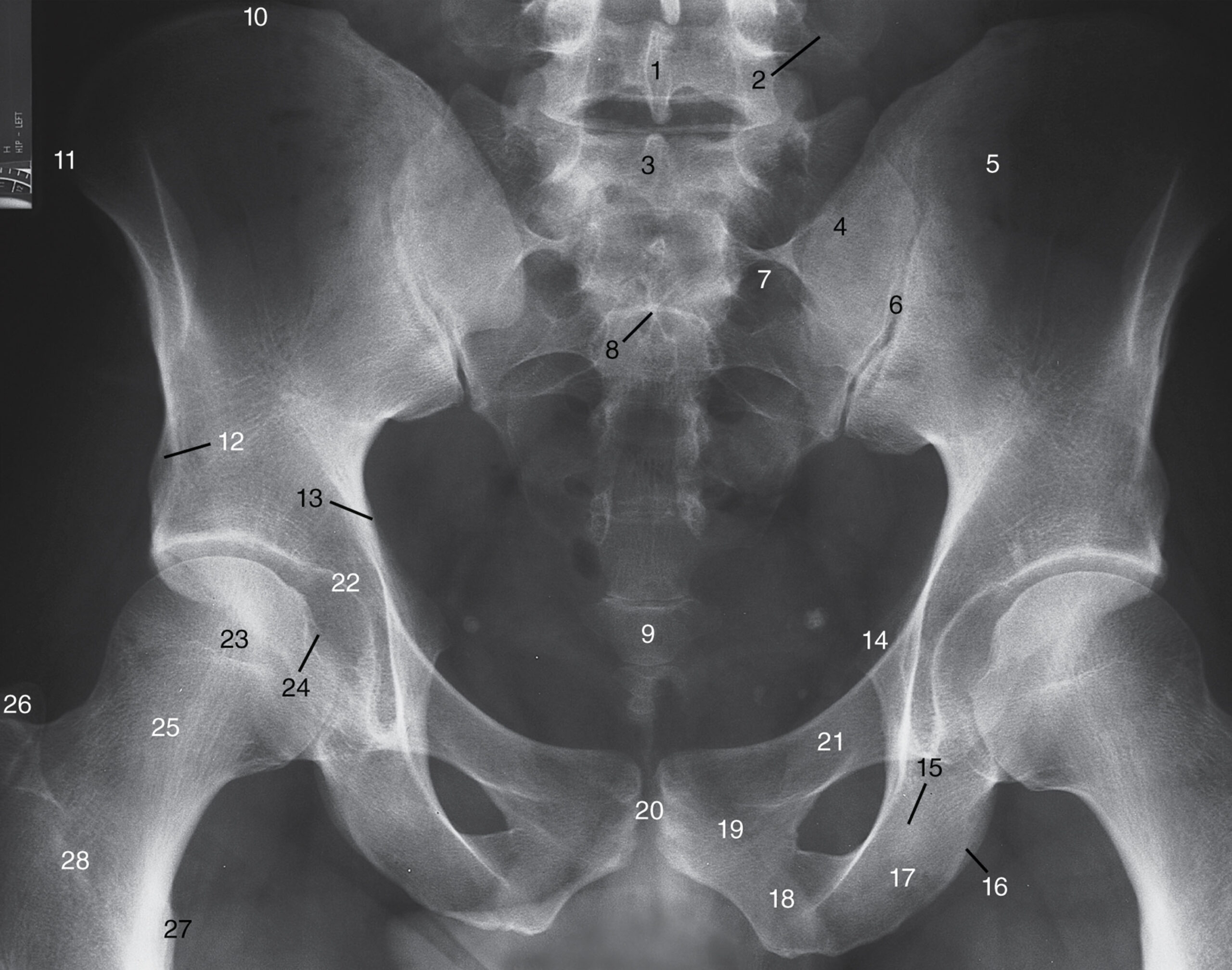 découvrez l'imagerie radiographique pelvienne, une technique médicale essentielle pour visualiser les os et structures du bassin afin de diagnostiquer fractures, anomalies et pathologies.