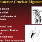 Temps de guérison du ligament croisé postérieur : que faut-il savoir ?