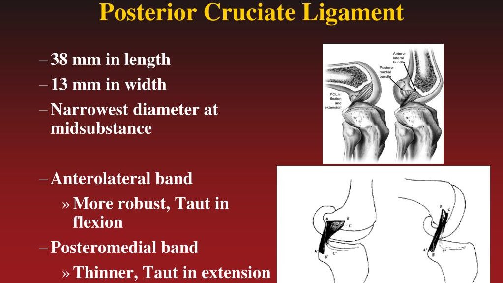découvrez le temps de guérison du ligament croisé postérieur, les étapes de récupération et les conseils pour un rétablissement optimal après une blessure.
