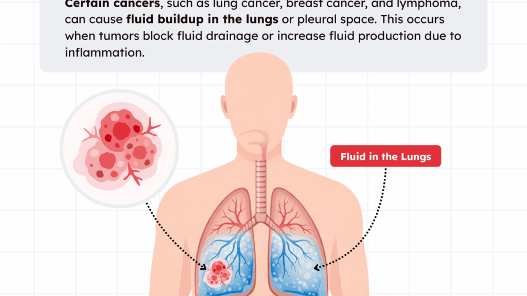 découvrez l'impact du cancer sur le liquide pulmonaire, ses implications pour le diagnostic et le traitement des maladies pulmonaires.