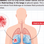 Eau dans les poumons et cancer : quel impact sur l’espérance de vie