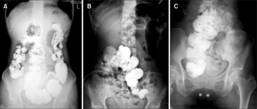 découvrez le pancolic fecal stasis, une condition caractérisée par une accumulation prolongée de matières fécales dans tout le côlon, entraînant des symptômes digestifs et nécessitant une prise en charge médicale adaptée.