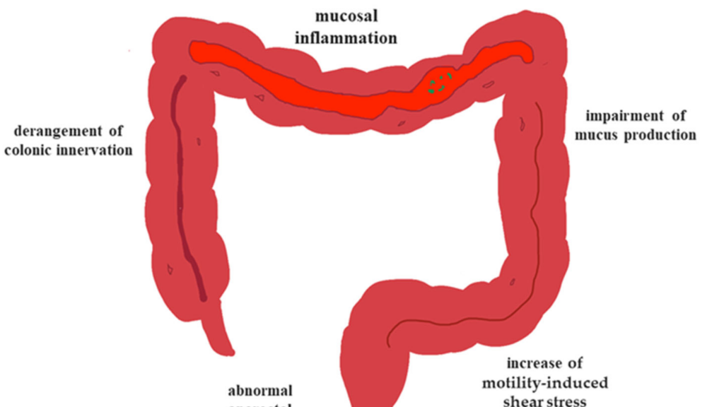 découvrez pancolic fecal stasis : une condition médicale caractérisée par une stase fécale généralisée nécessitant une prise en charge adaptée pour éviter les complications digestives.