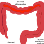 Stase stercorale pancolique : causes, symptômes et traitements