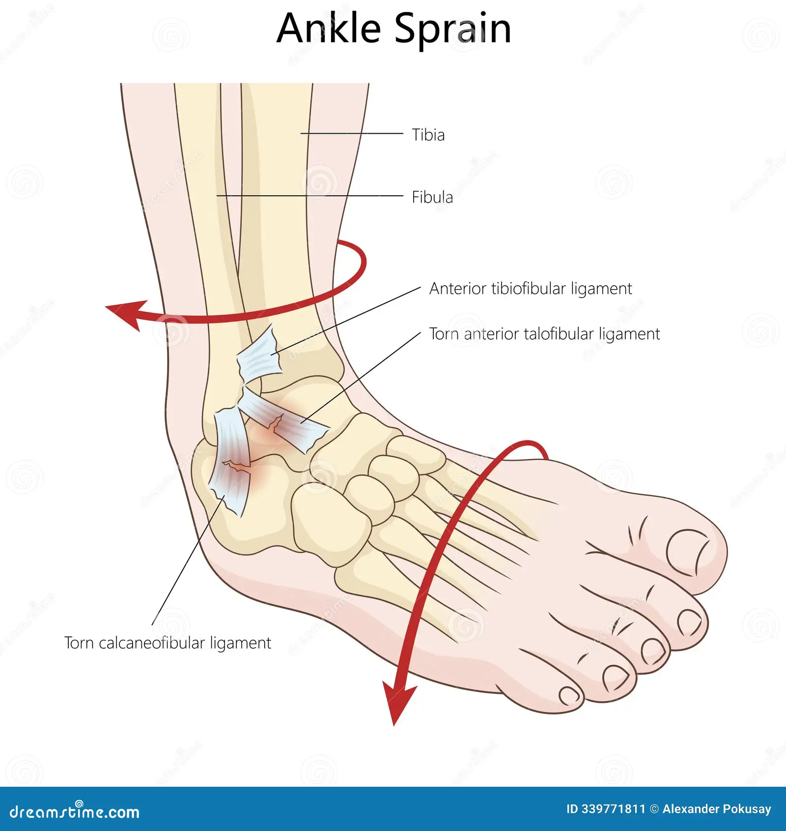 découvrez les causes, symptômes et traitements de la rupture des ligaments de la cheville pour une prise en charge rapide et efficace.