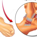 découvrez tout sur la rupture des ligaments de la cheville : symptômes, causes, traitements et conseils pour une récupération efficace.