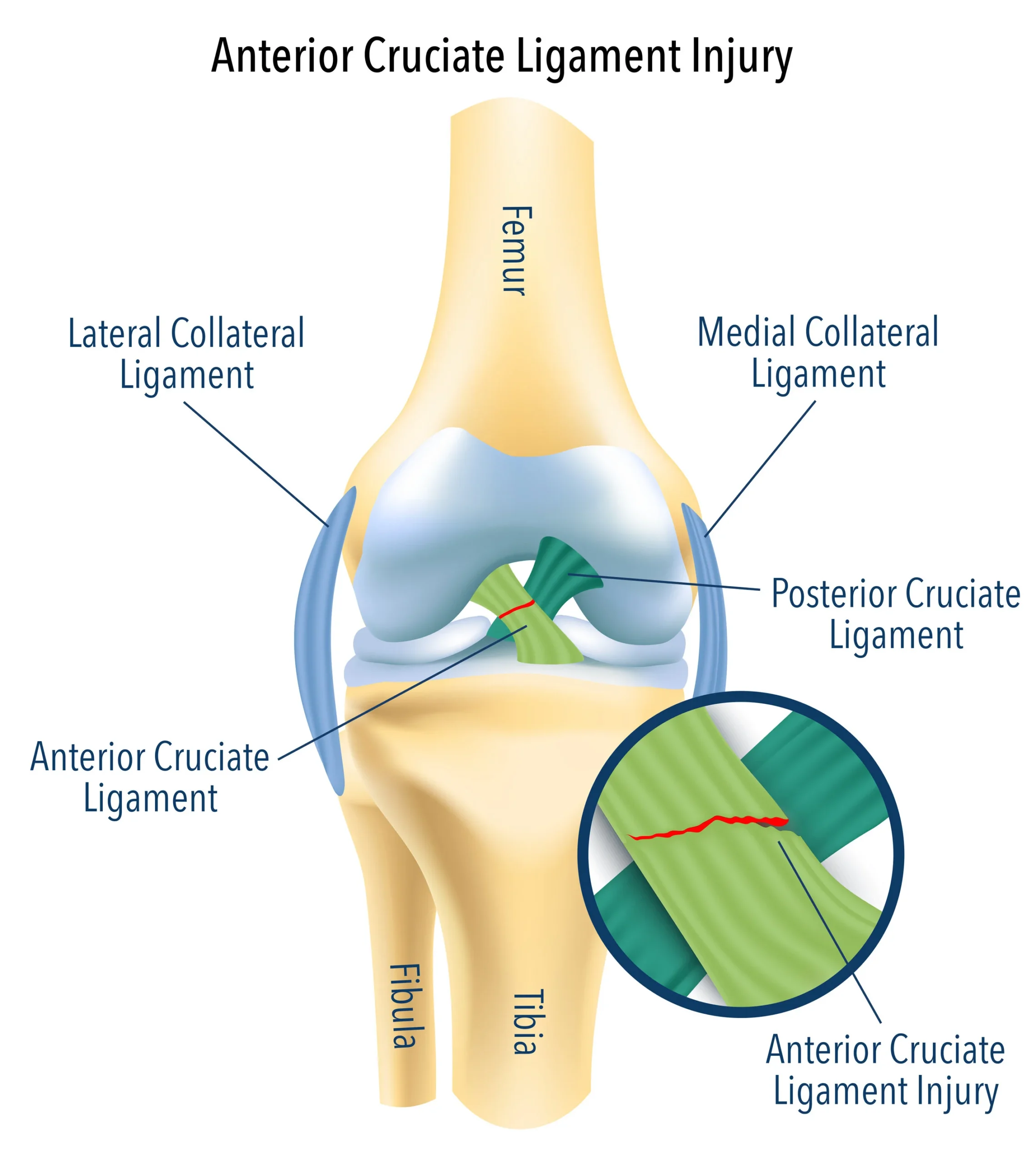 découvrez tout sur le ligament croisé antérieur : anatomie, blessures courantes, symptômes, traitements et rééducation pour un genou en pleine santé.