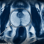 Déroulement d&rsquo;une irm de la prostate : ce à quoi s&rsquo;attendre