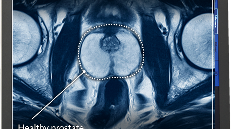 découvrez tout ce qu'il faut savoir sur la procédure d'irm de la prostate : préparation, déroulement et utilité pour un diagnostic précis.