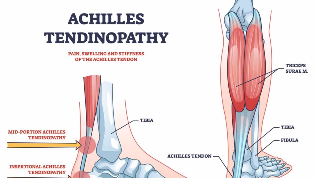 découvrez les options de traitement efficaces pour la tendinite d'achille afin de soulager la douleur et favoriser une guérison rapide.