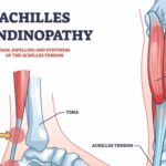 découvrez les options de traitement efficaces pour la tendinite d'achille afin de soulager la douleur et favoriser une guérison rapide.