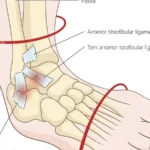 Ligament cheville distendu : symptômes, causes et traitements efficaces