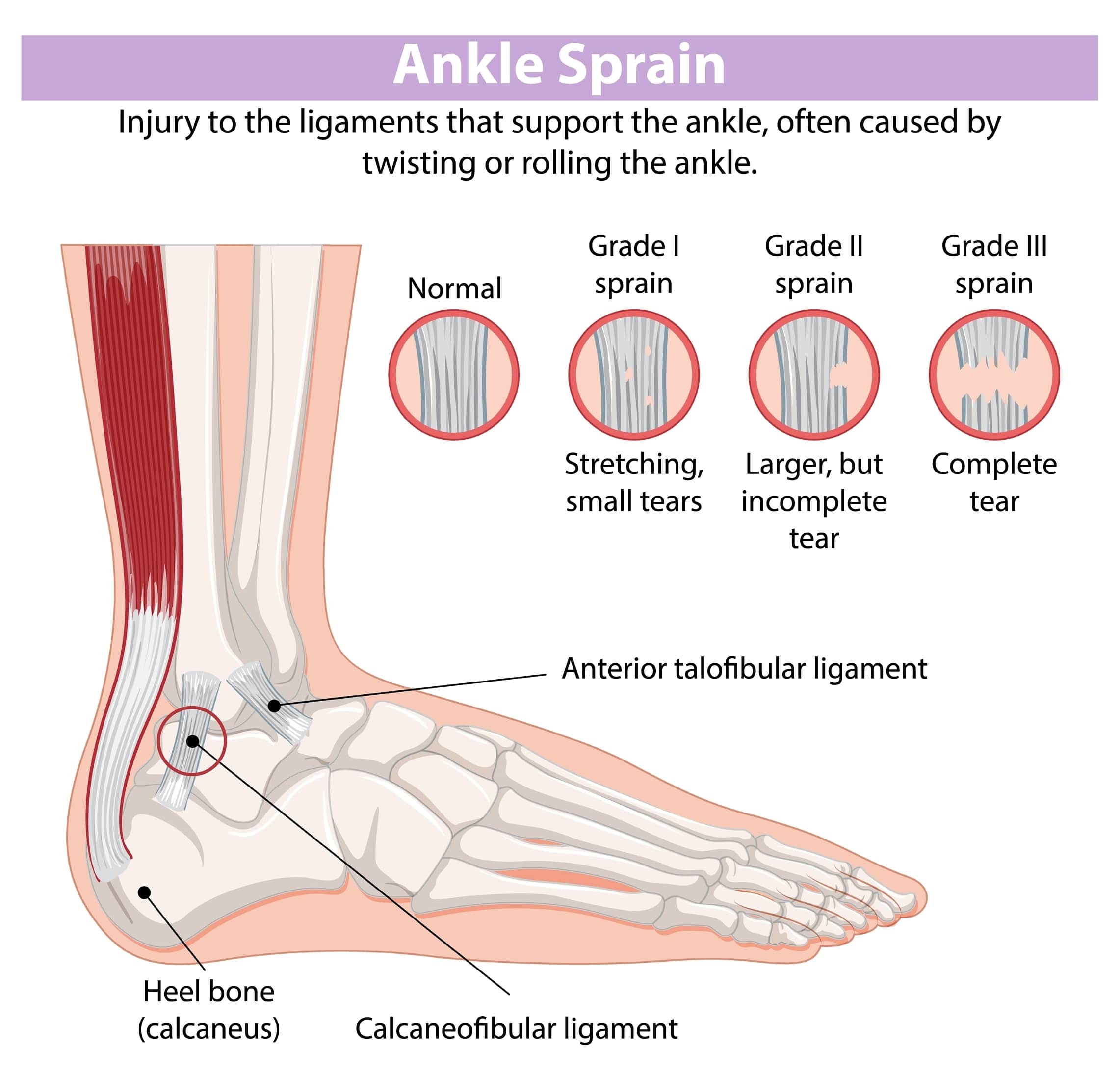 découvrez tout sur l'entorse des ligaments de la cheville : symptômes, causes, traitements et conseils pour une récupération rapide et efficace.