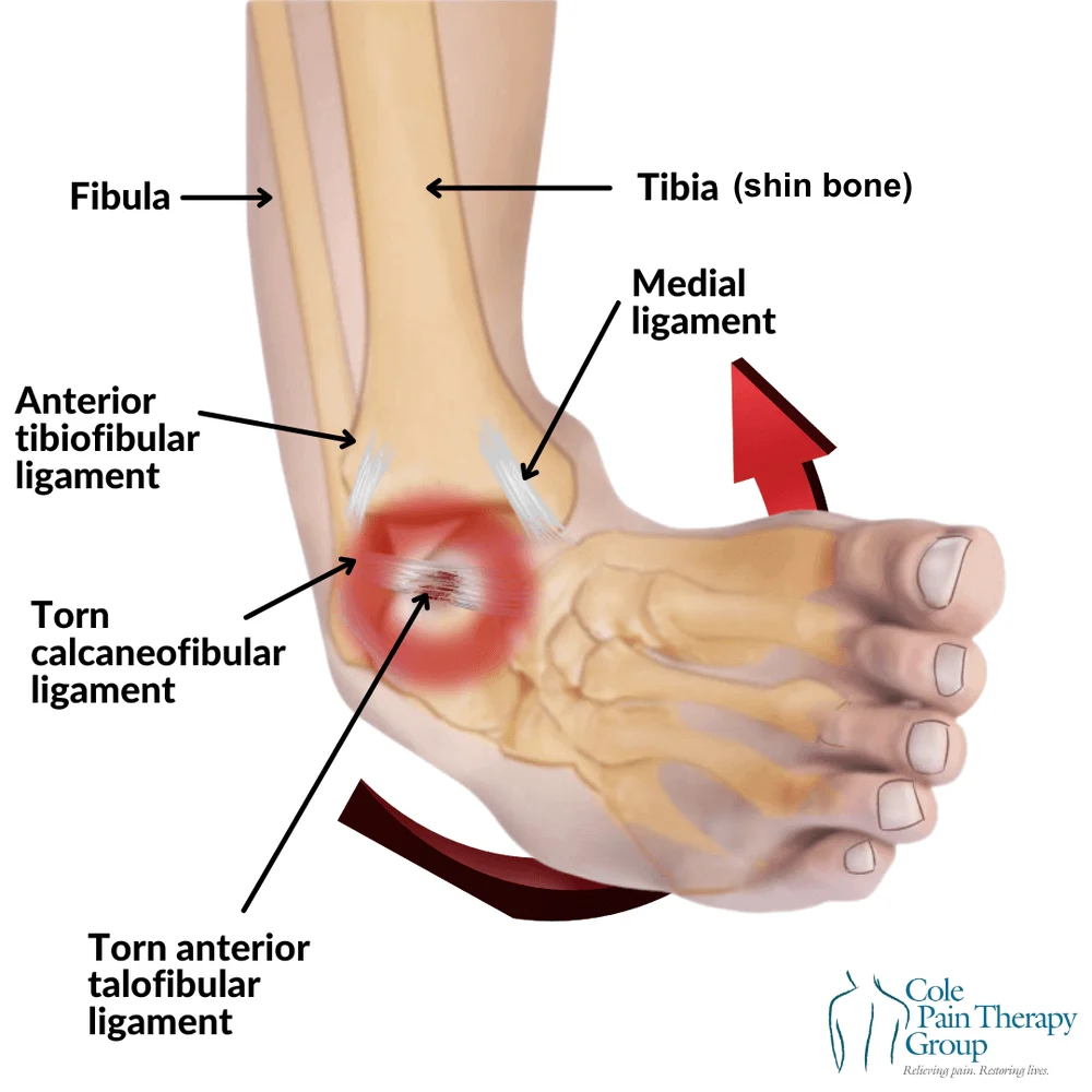 découvrez tout sur la déchirure des ligaments de la cheville : symptômes, causes, traitement et prévention pour une récupération optimale.
