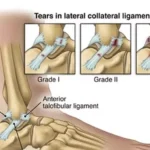 Rupture des ligaments de la cheville : comprendre les causes et les traitements
