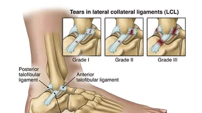 découvrez les causes, symptômes et traitements de la déchirure des ligaments de la cheville pour une récupération optimale et un retour rapide à vos activités.