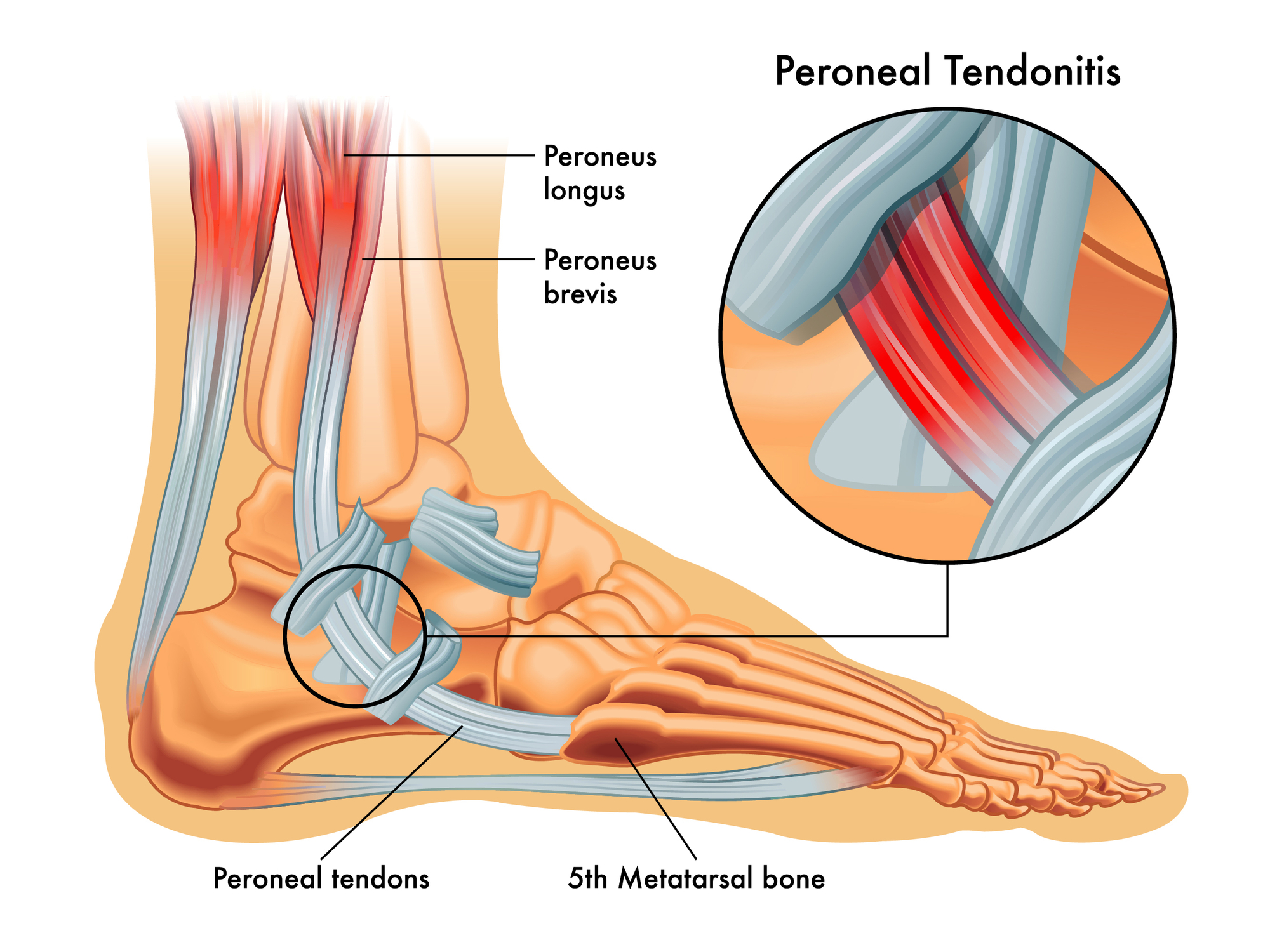 découvrez tout sur la tendinite du pied : symptômes, causes, traitements et conseils pour une récupération optimale.