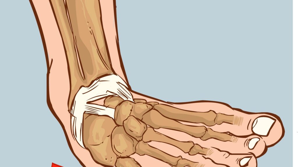 découvrez tout ce qu'il faut savoir sur l'entorse : symptômes, causes, traitement et conseils pour une récupération rapide et efficace.